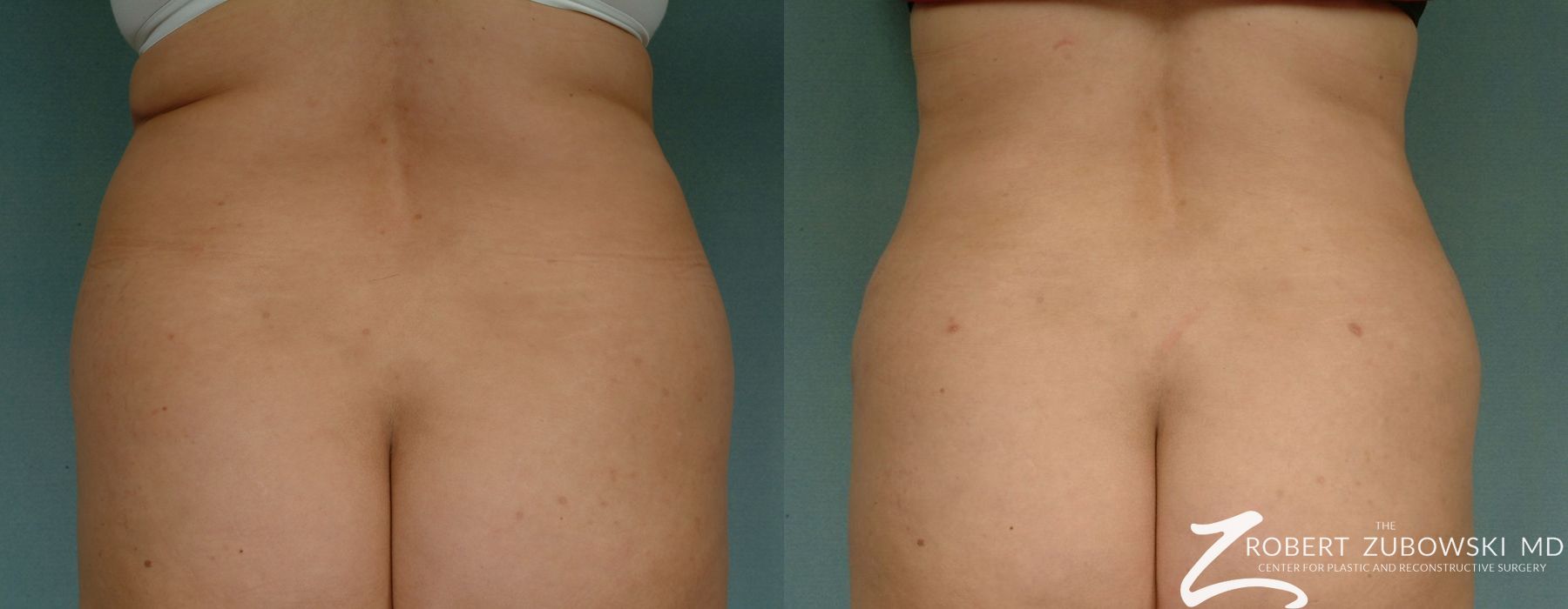 Liposuction - Case 3548