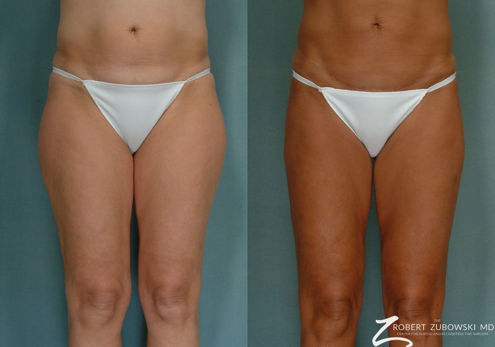 Liposuction - Thumbnail 3