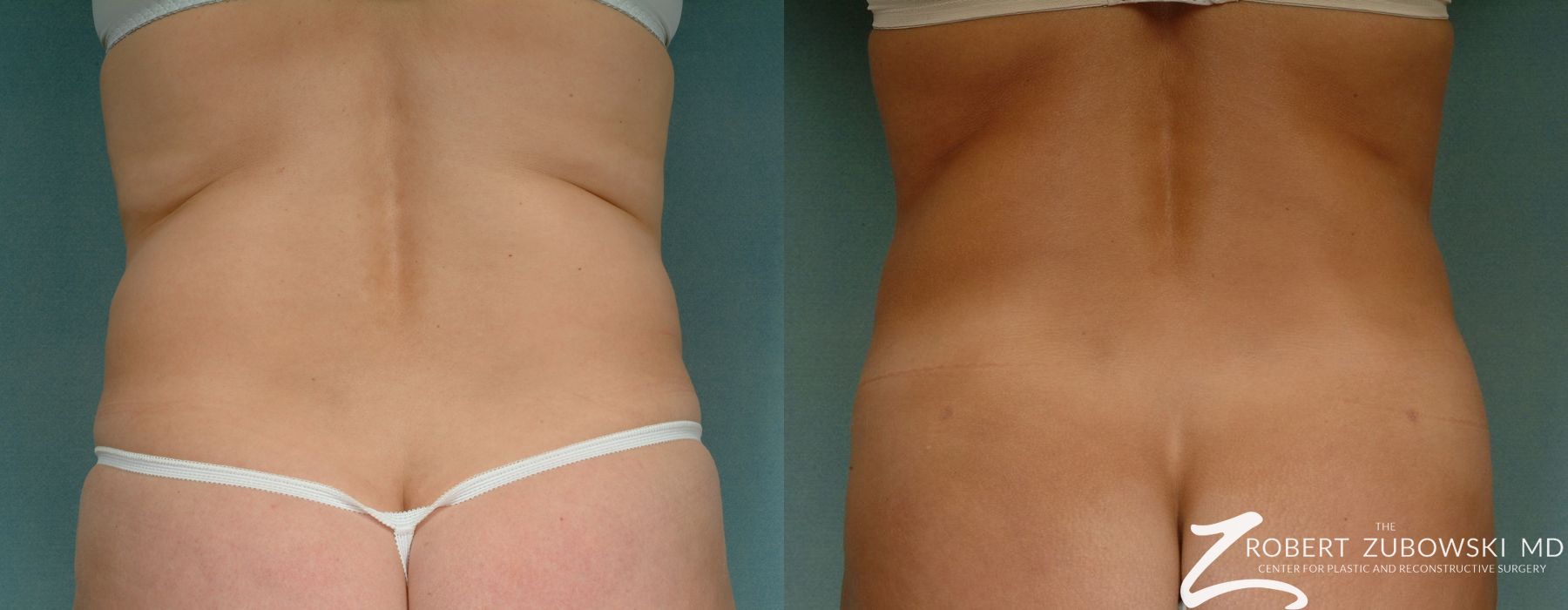 Liposuction - Thumbnail 4