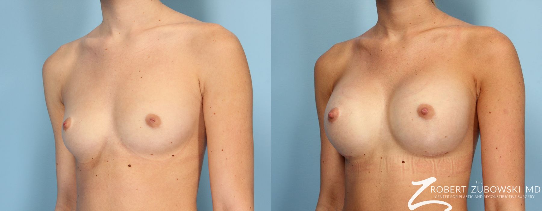 Breast Augmentation - Thumbnail 2