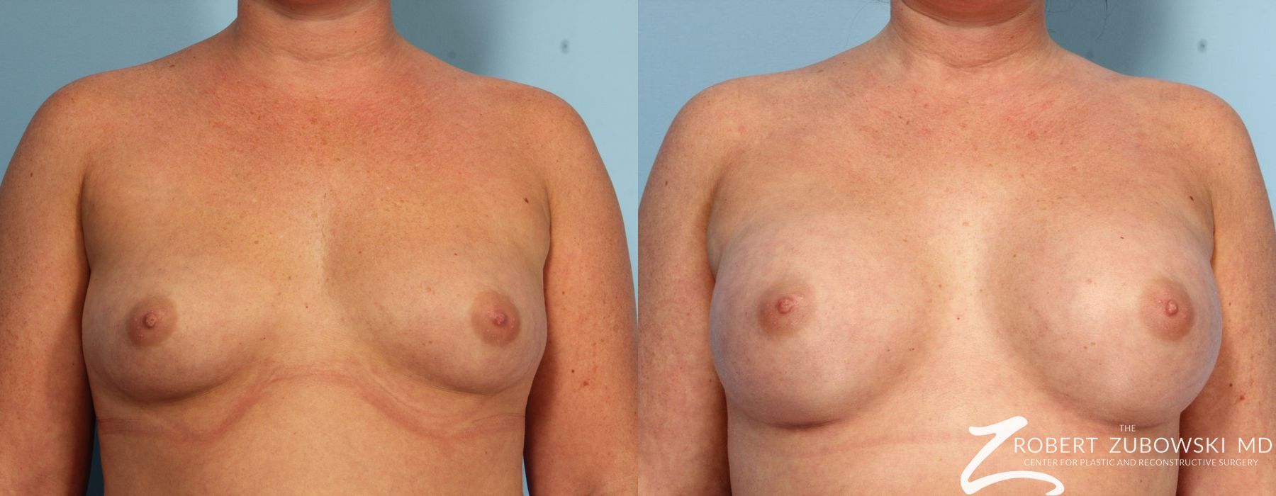 Before and after procedure result