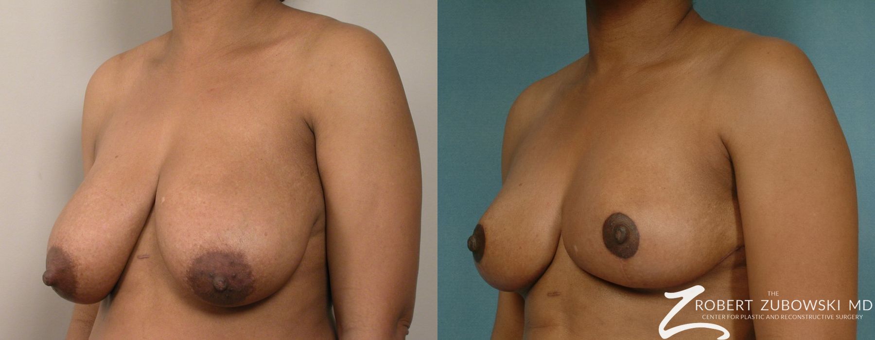 Breast Reduction - Thumbnail 2