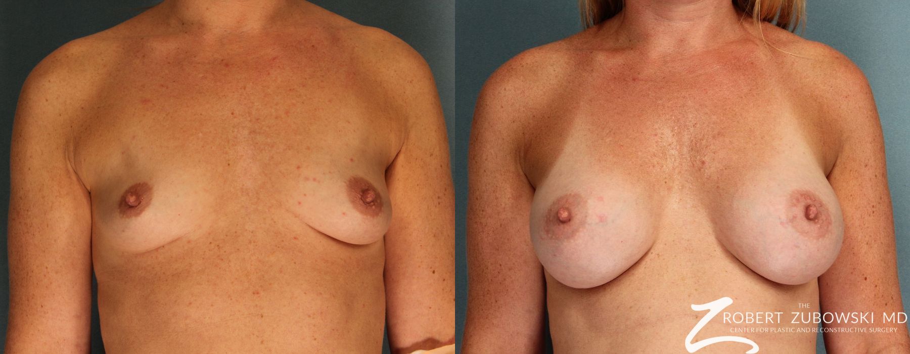 Before and after procedure result