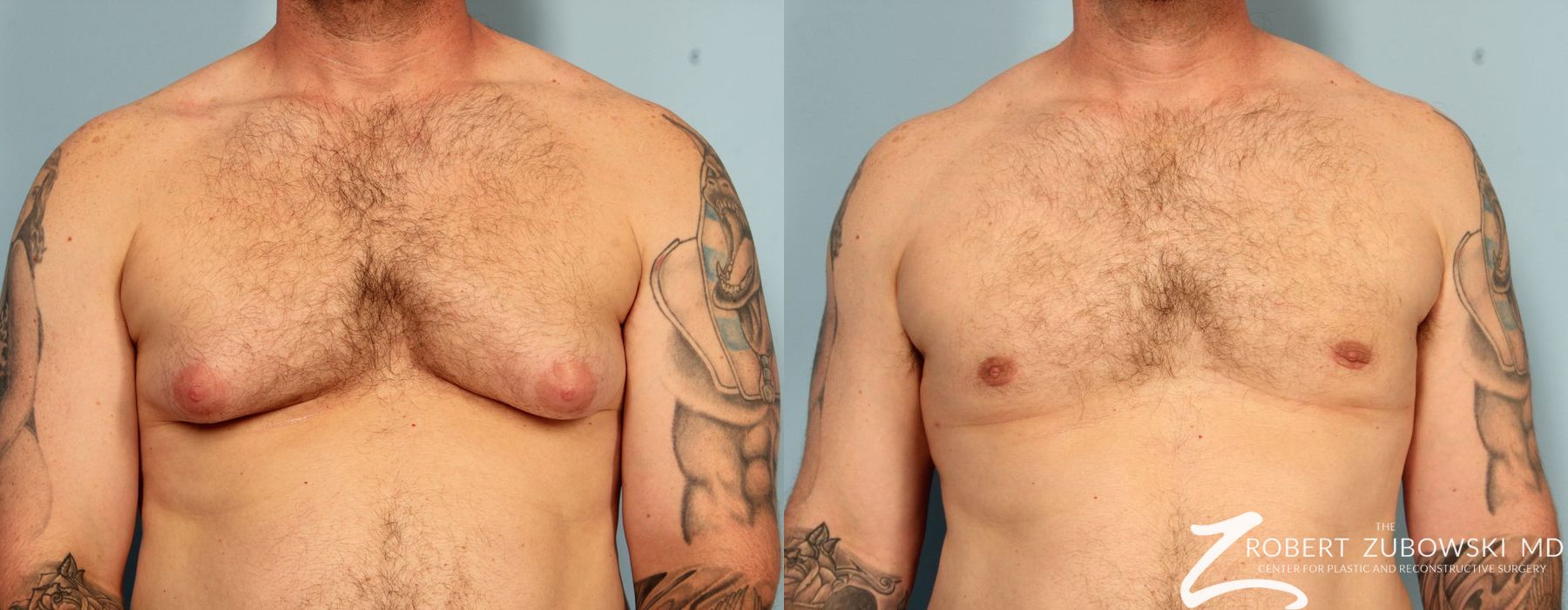 Gynecomastia - Case 3730