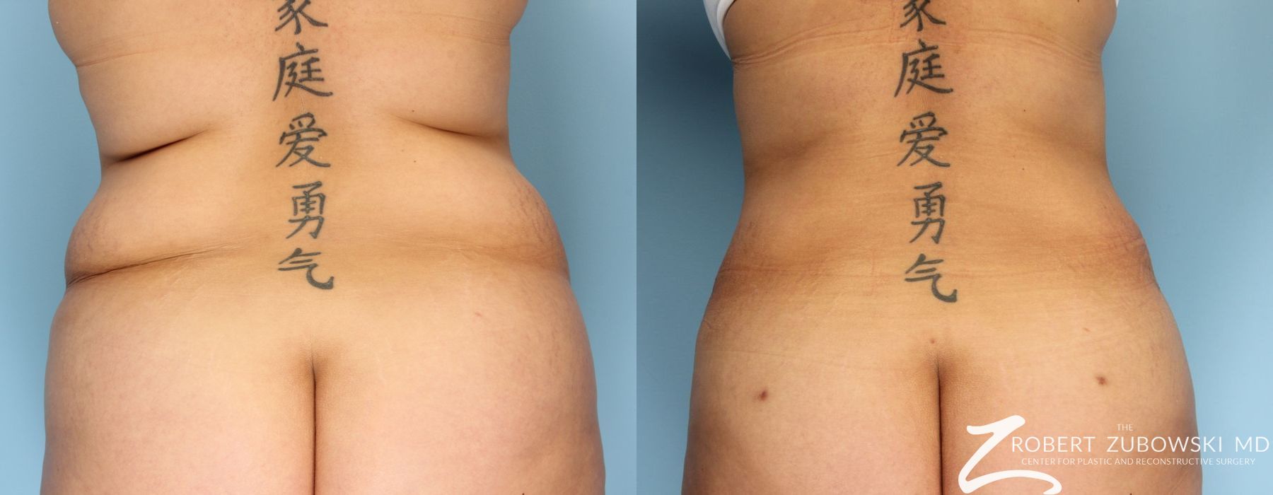 Liposuction - Case 3536