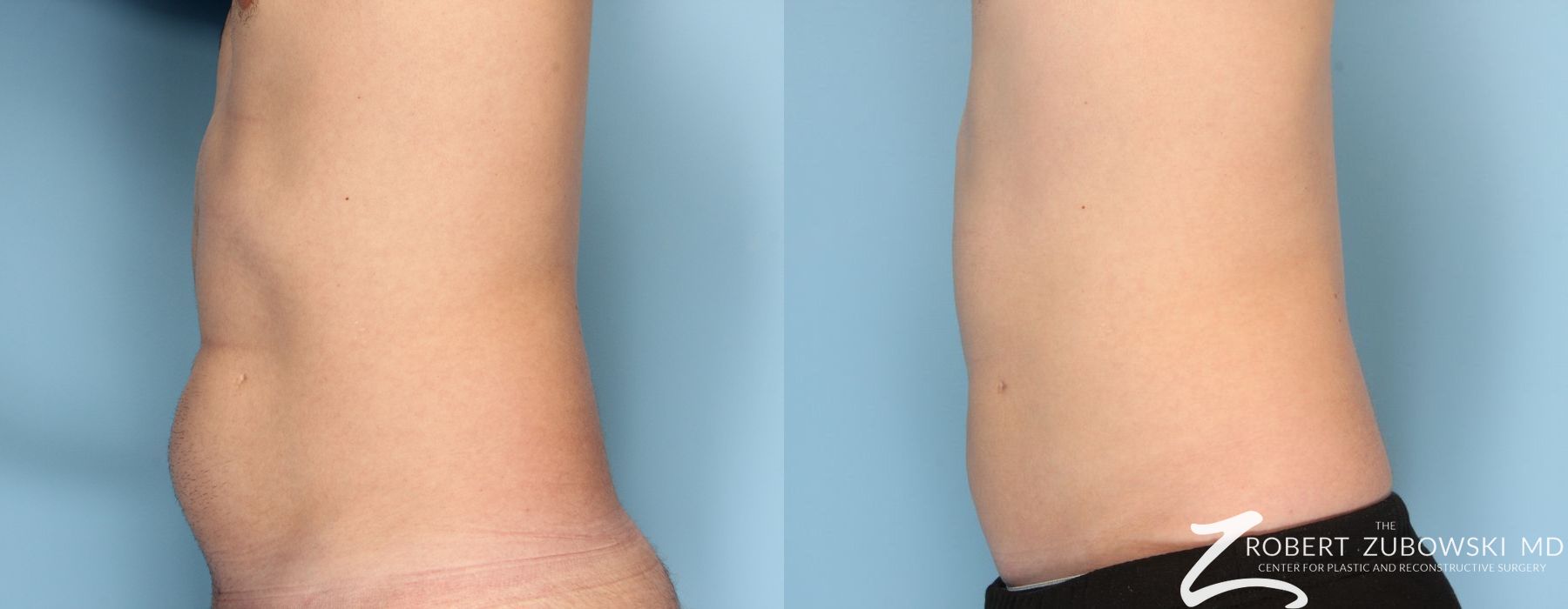 Liposuction - Thumbnail 2