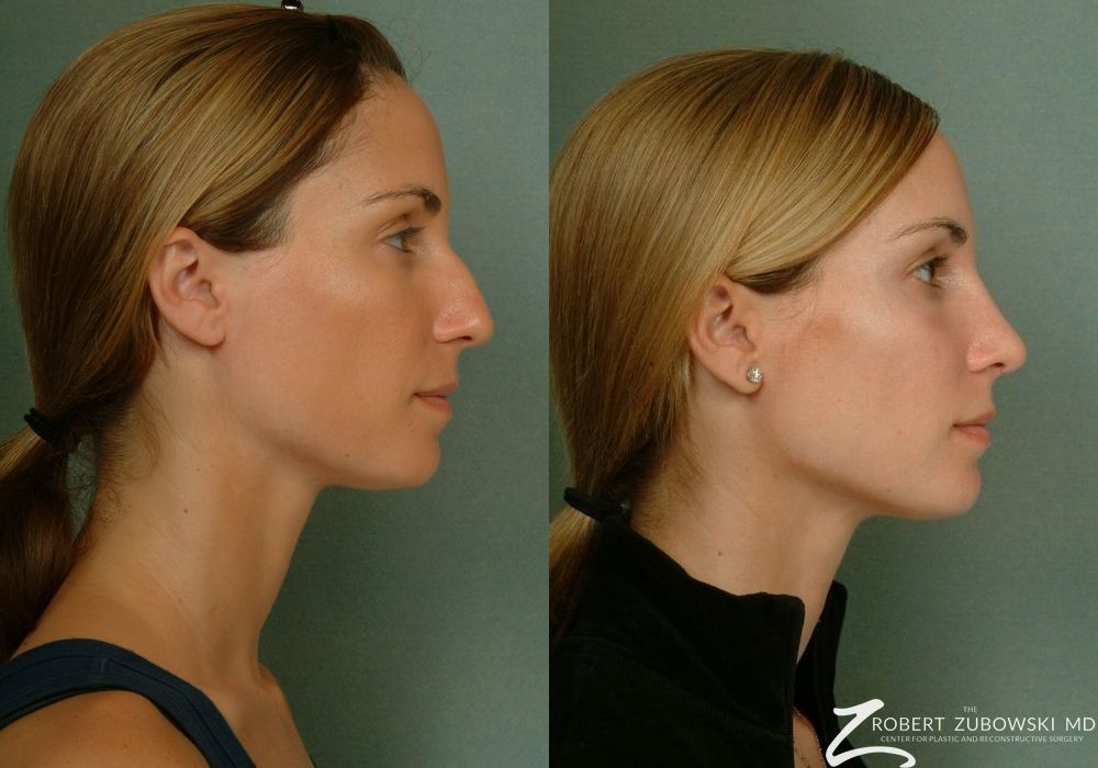 Rhinoplasty - Thumbnail 2