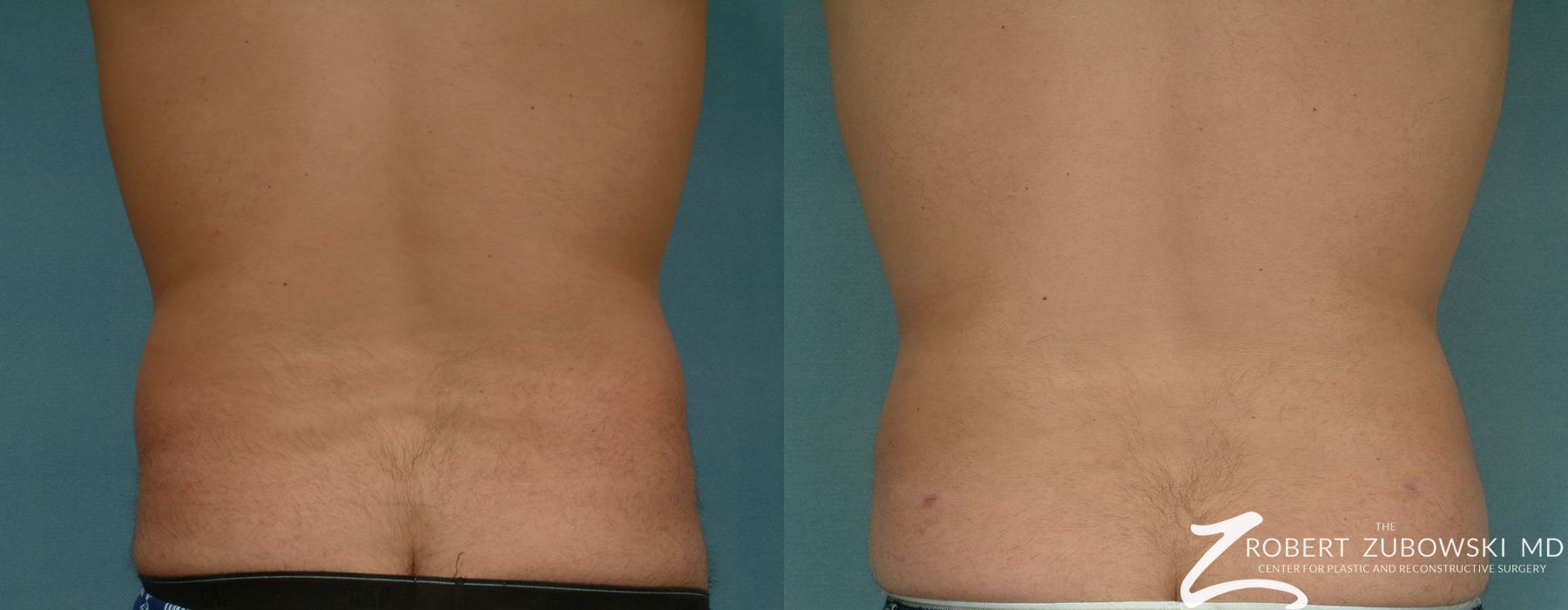 Liposuction - Thumbnail 2