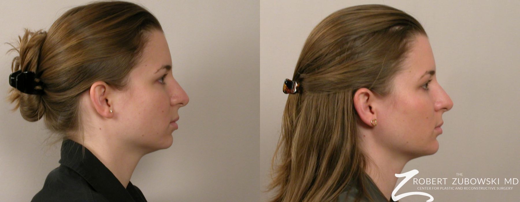 Chin Augmentation - Thumbnail 2