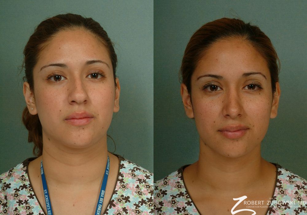 Rhinoplasty - Case 3895