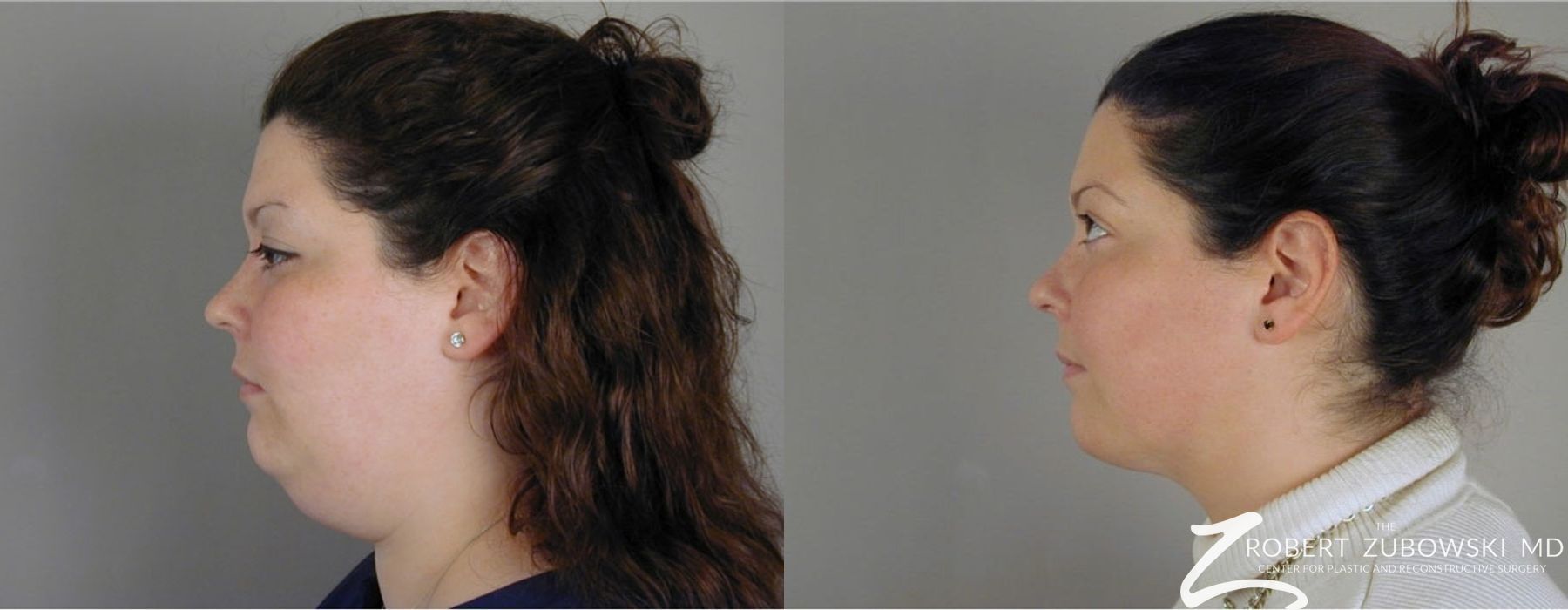 Liposuction - Case 3564