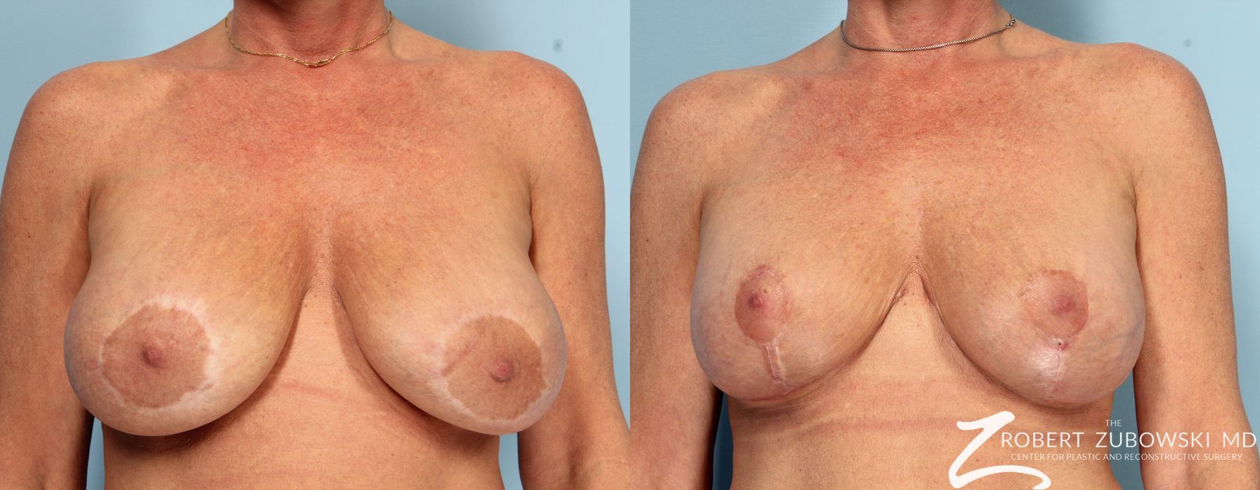 Breast Lift and Augmentation - Case 3680