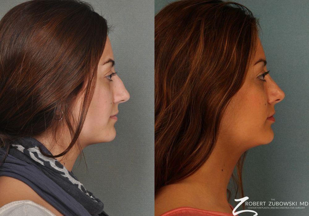 Rhinoplasty - Thumbnail 2