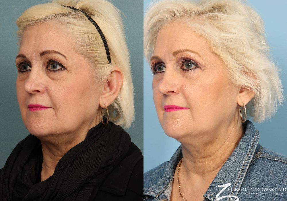 Blepharoplasty - Thumbnail 2