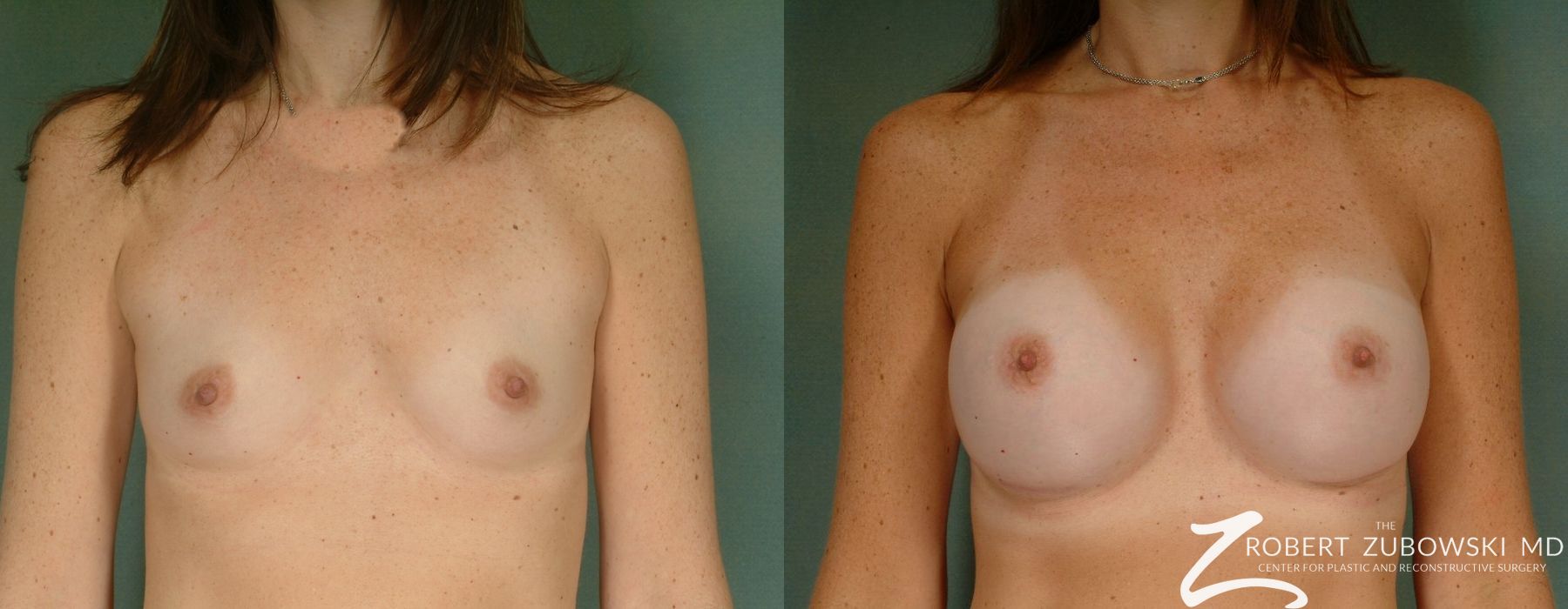 Breast Augmentation - Case 3630