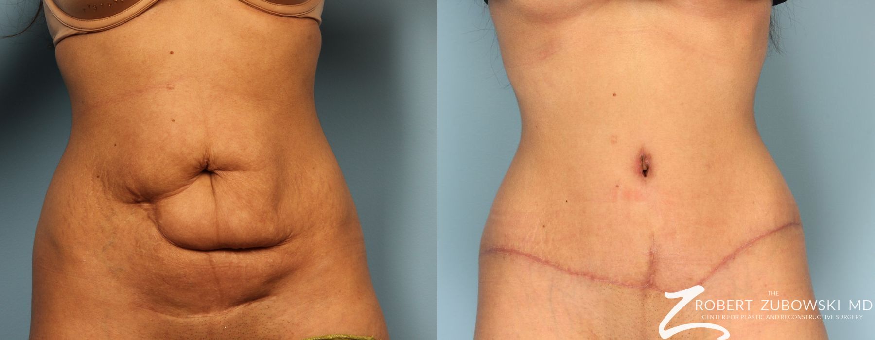Tummy Tuck - Case 3581