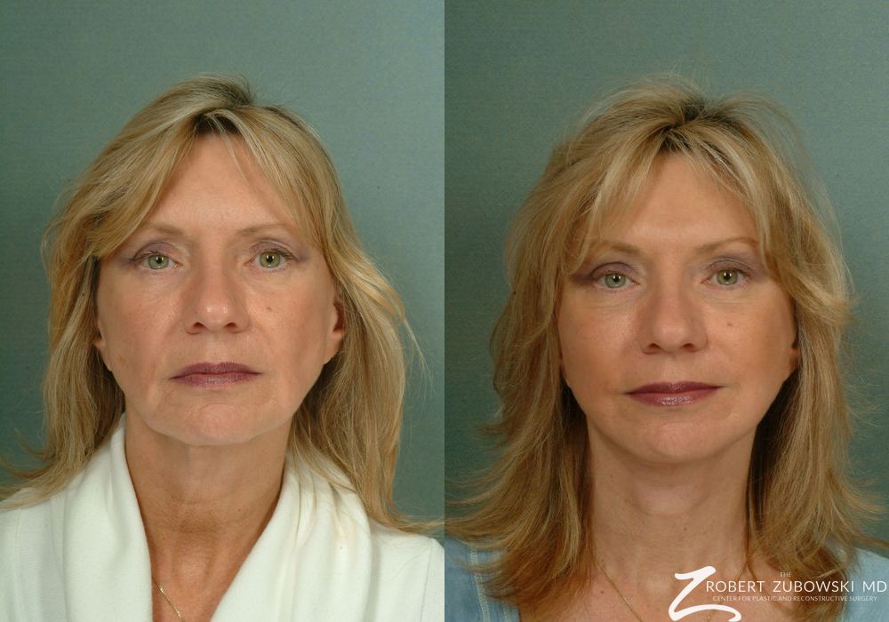 Before and after procedure result