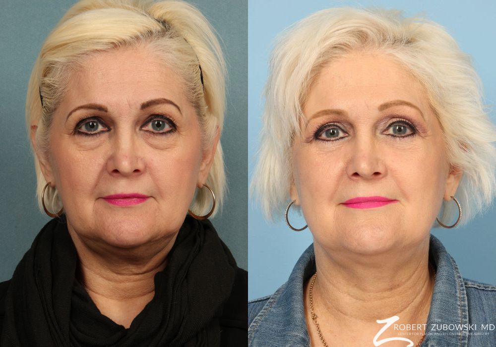 Blepharoplasty - Case 3739