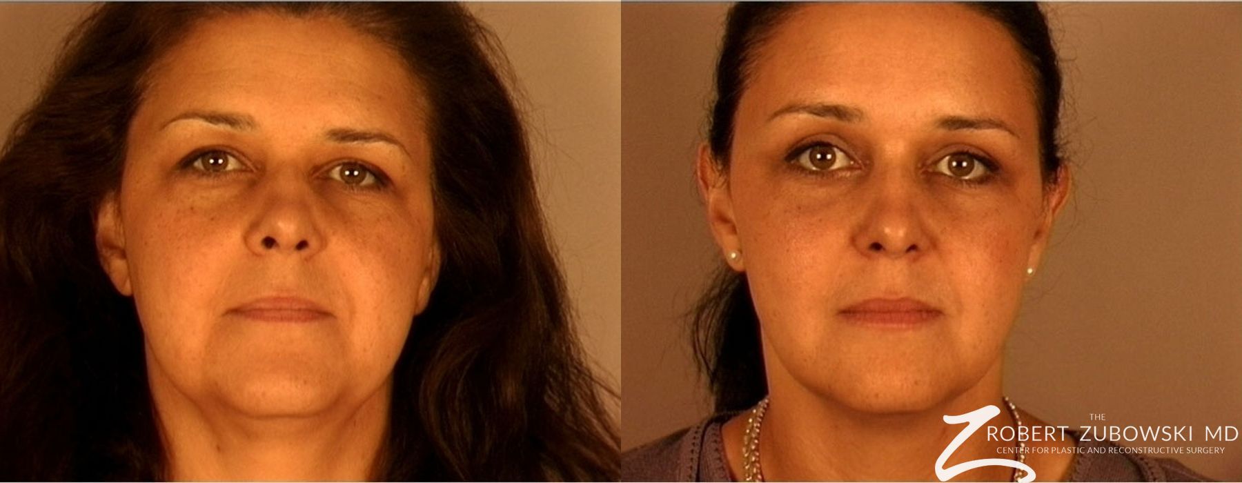 Brow Lift - Case 3782