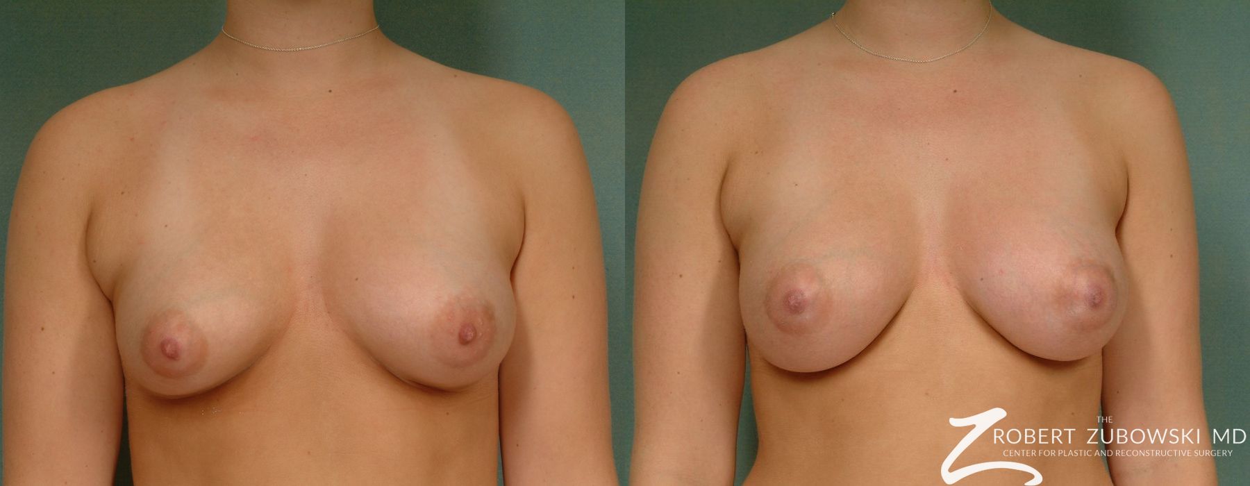Breast Augmentation - Case 3626