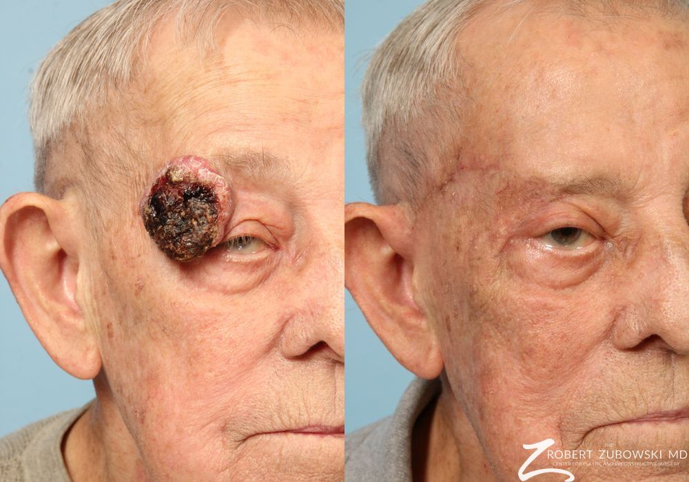 Mohs Closure - Case 3840