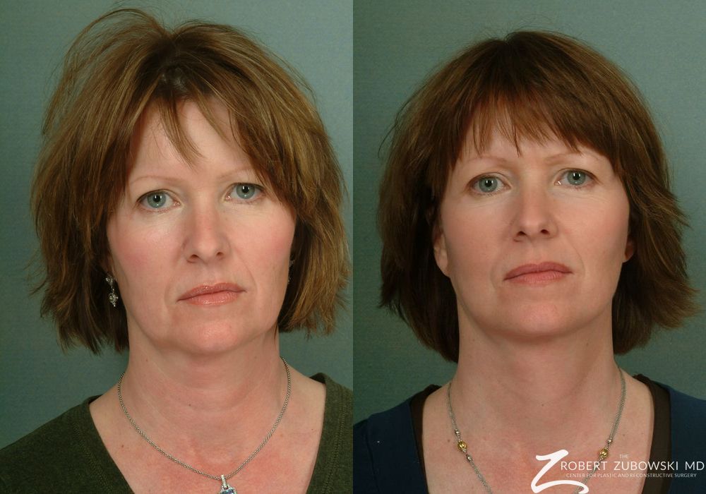 Before and after procedure result