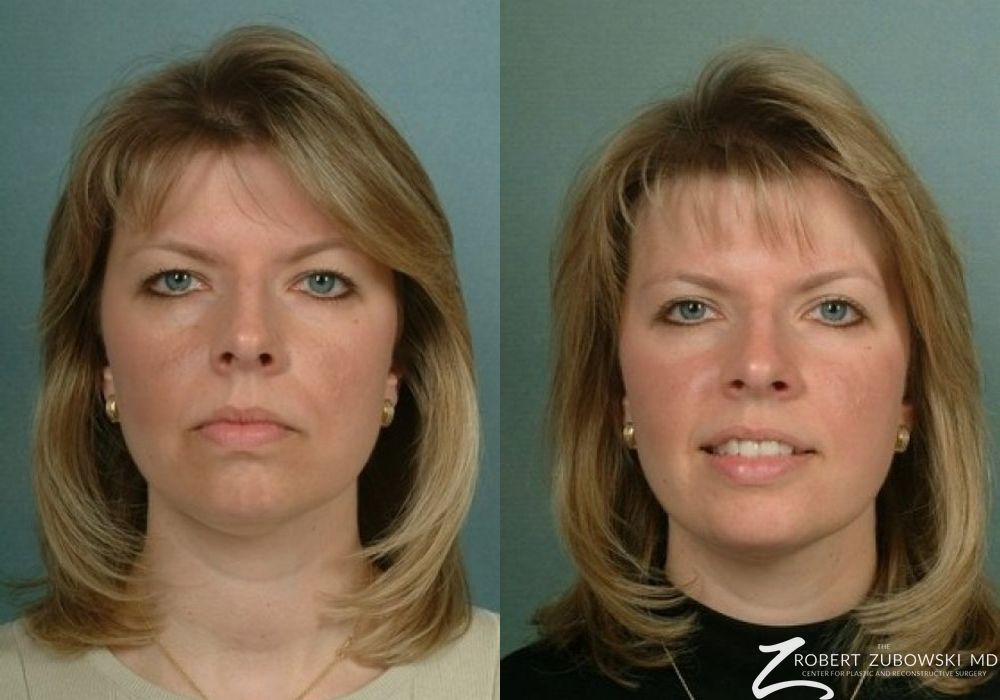 Blepharoplasty - Case 3744