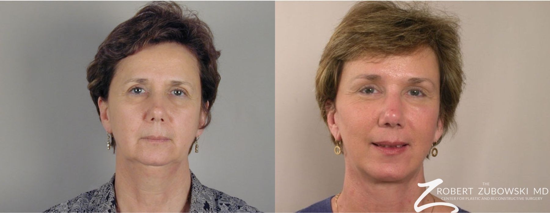 Brow Lift - Case 3781