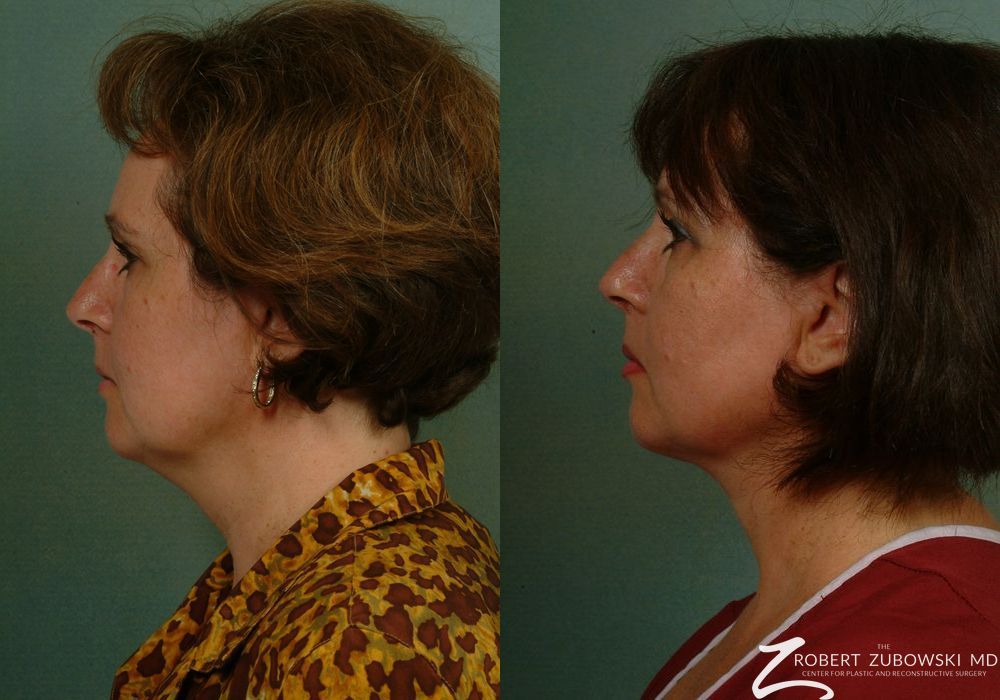 Facelift - Thumbnail 2