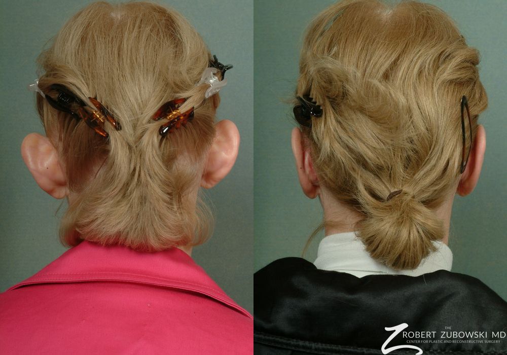 Otoplasty - Thumbnail 2