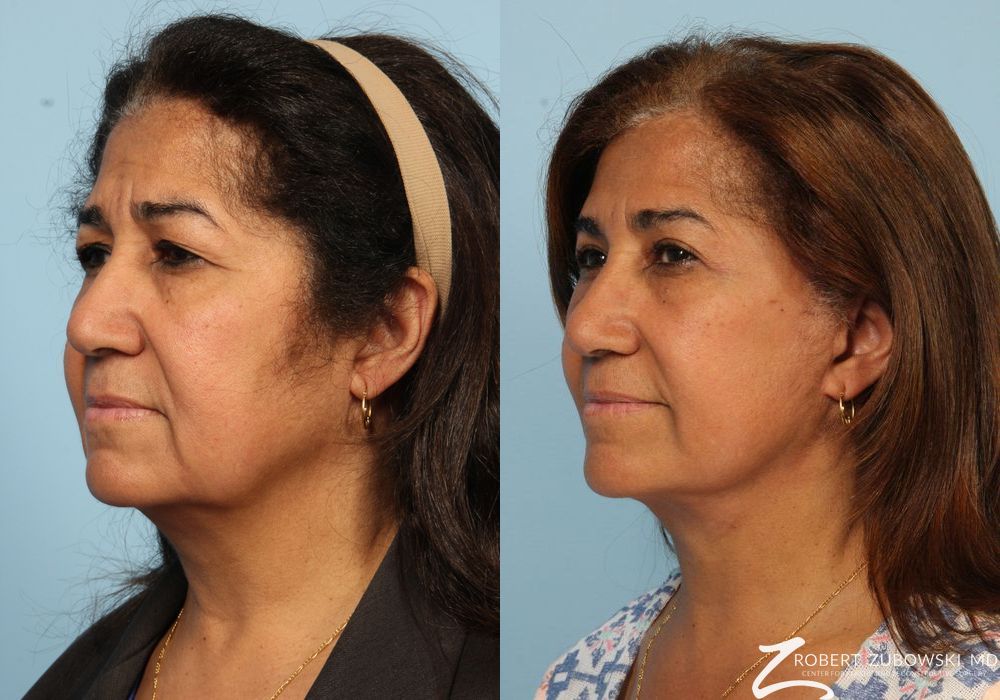 Blepharoplasty - Thumbnail 2