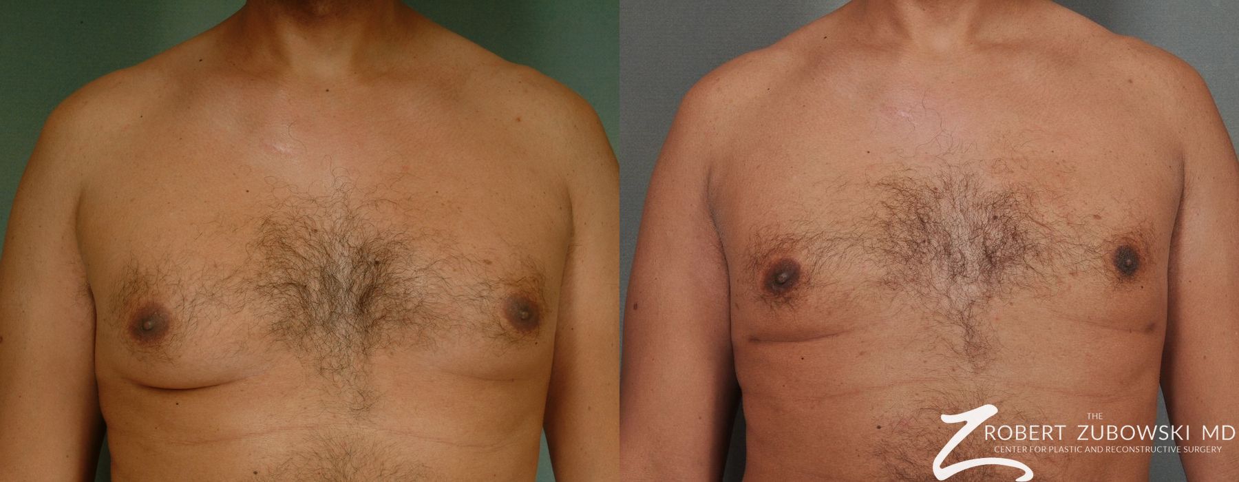 Gynecomastia - Case 3725