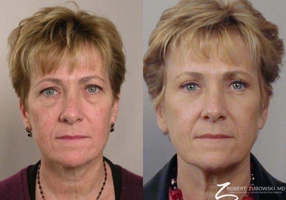 Blepharoplasty - Case 4199