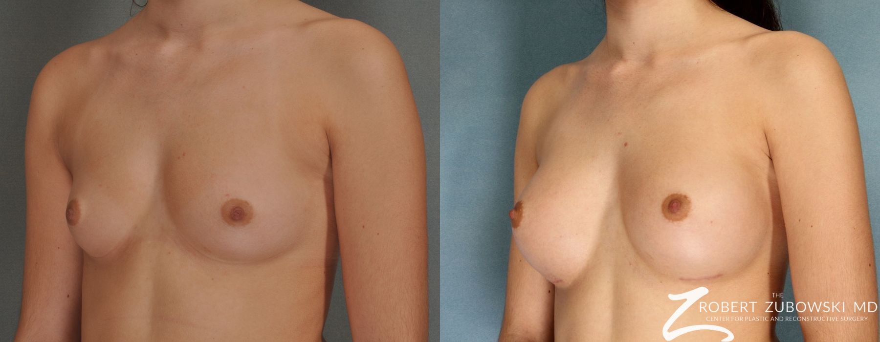 Breast Augmentation - Thumbnail 2