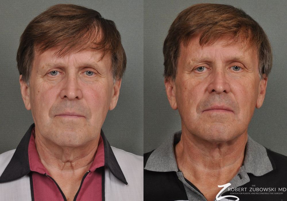 Neck Lift - Case 3843