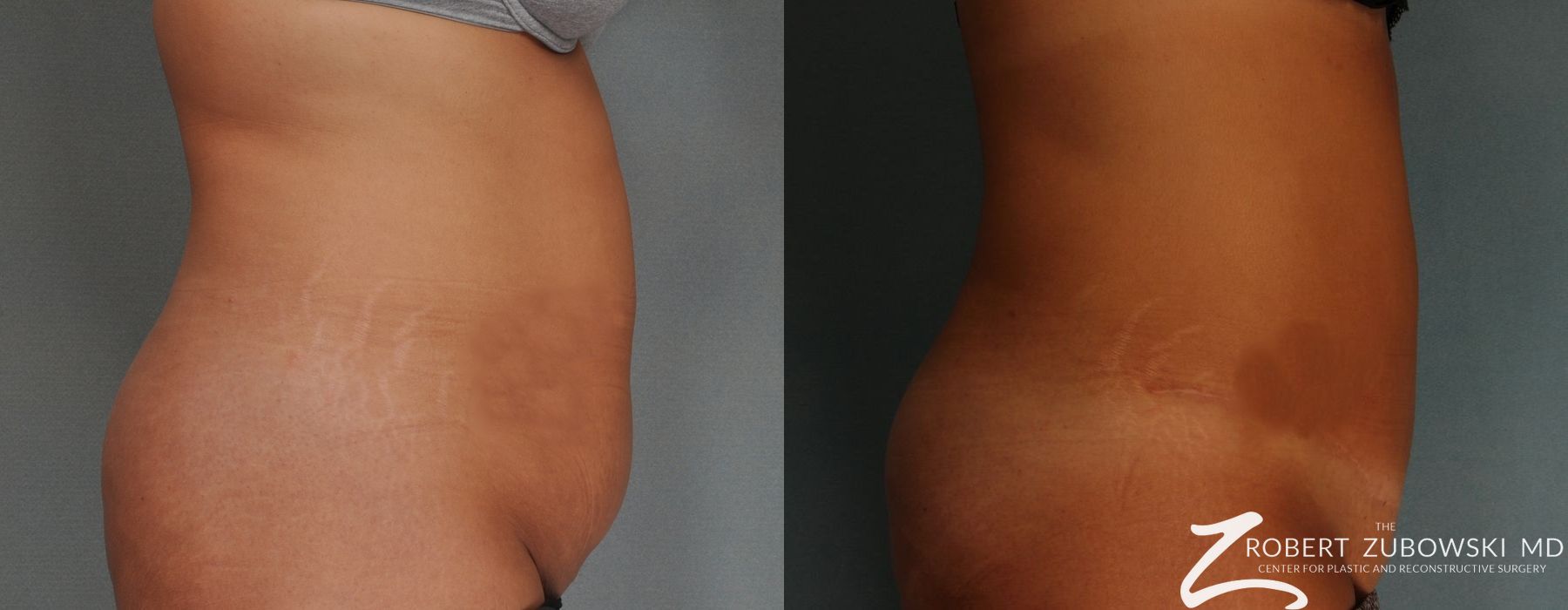 Tummy Tuck - Thumbnail 2