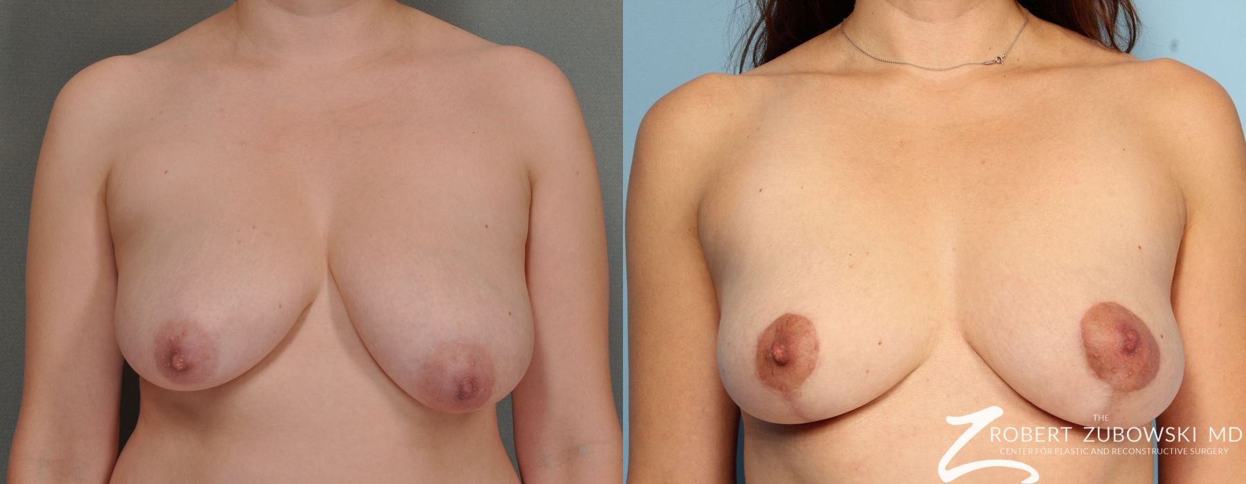 Breast Lift - Case 3656
