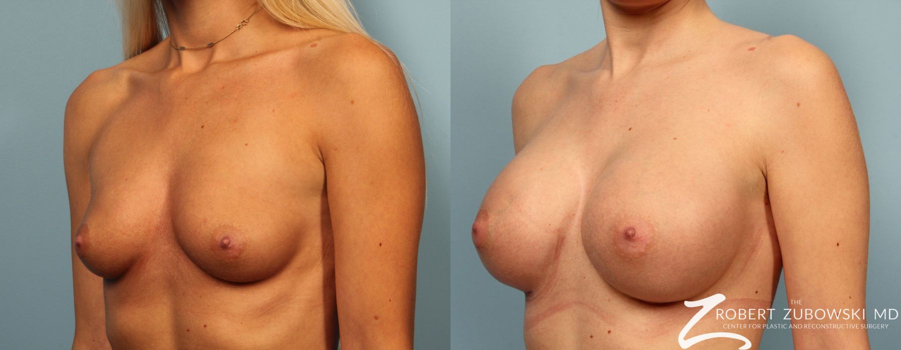Breast Augmentation - Thumbnail 2