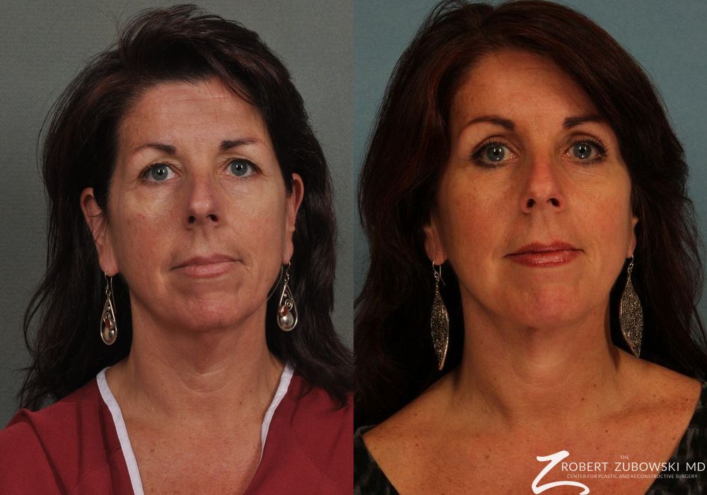 Neck Lift - Case 3845