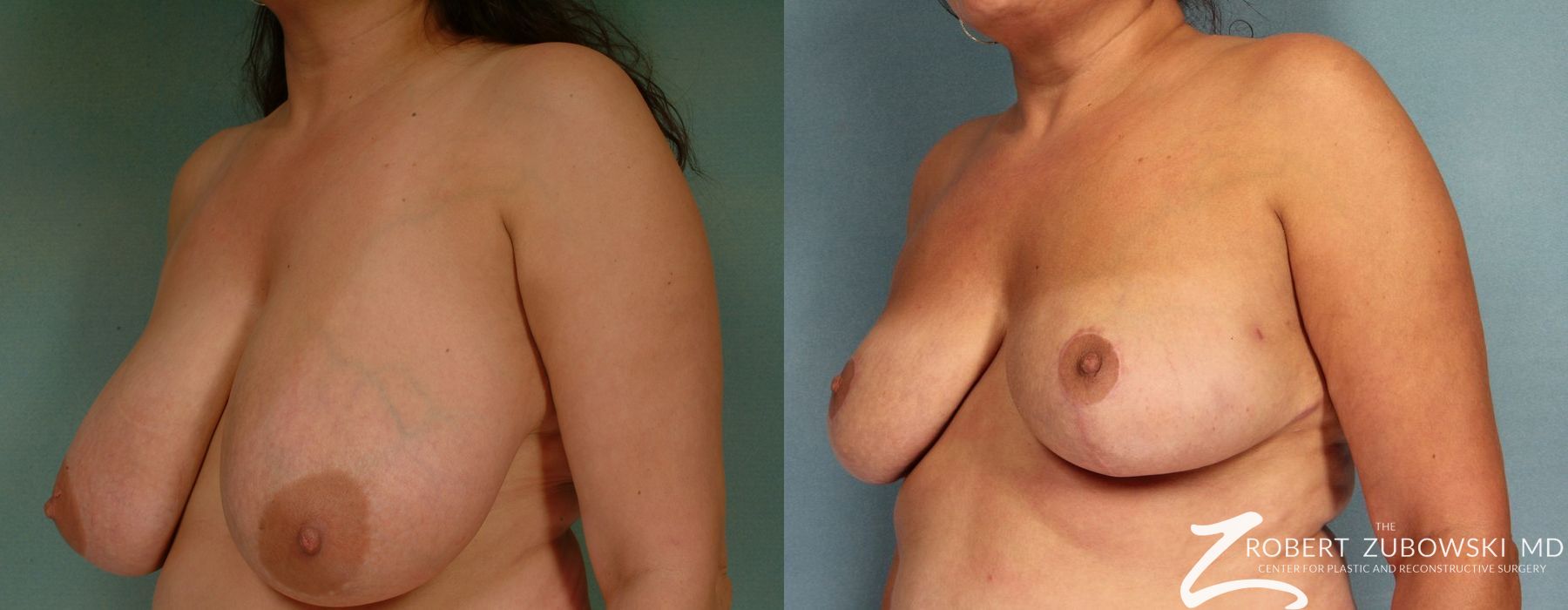Breast Reduction - Thumbnail 2