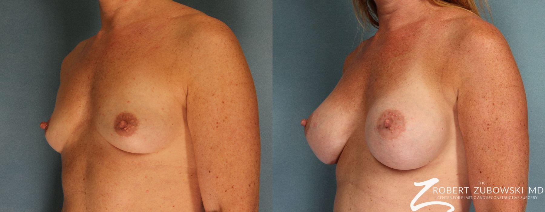 Breast Augmentation - Thumbnail 2