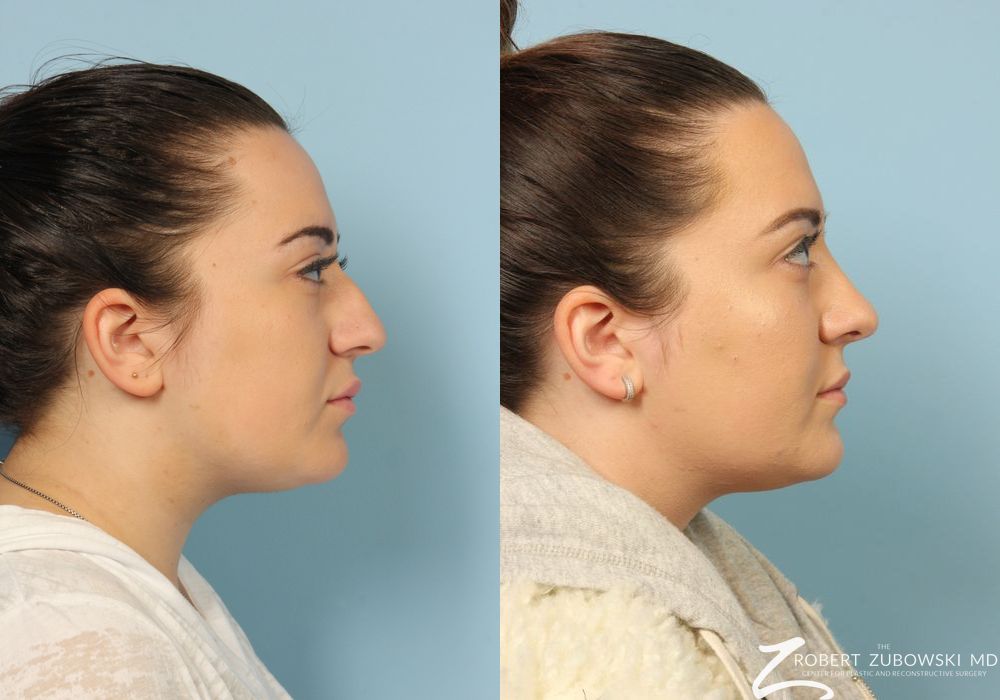 Rhinoplasty - Thumbnail 3