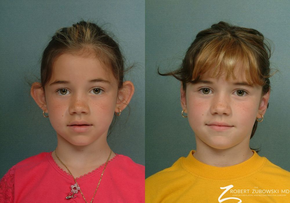 Otoplasty - Case 3857