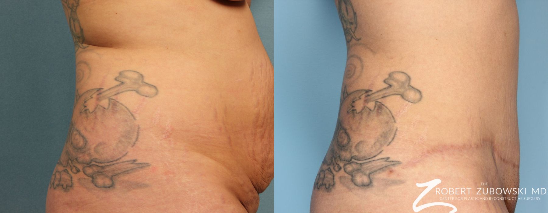 Tummy Tuck - Thumbnail 2