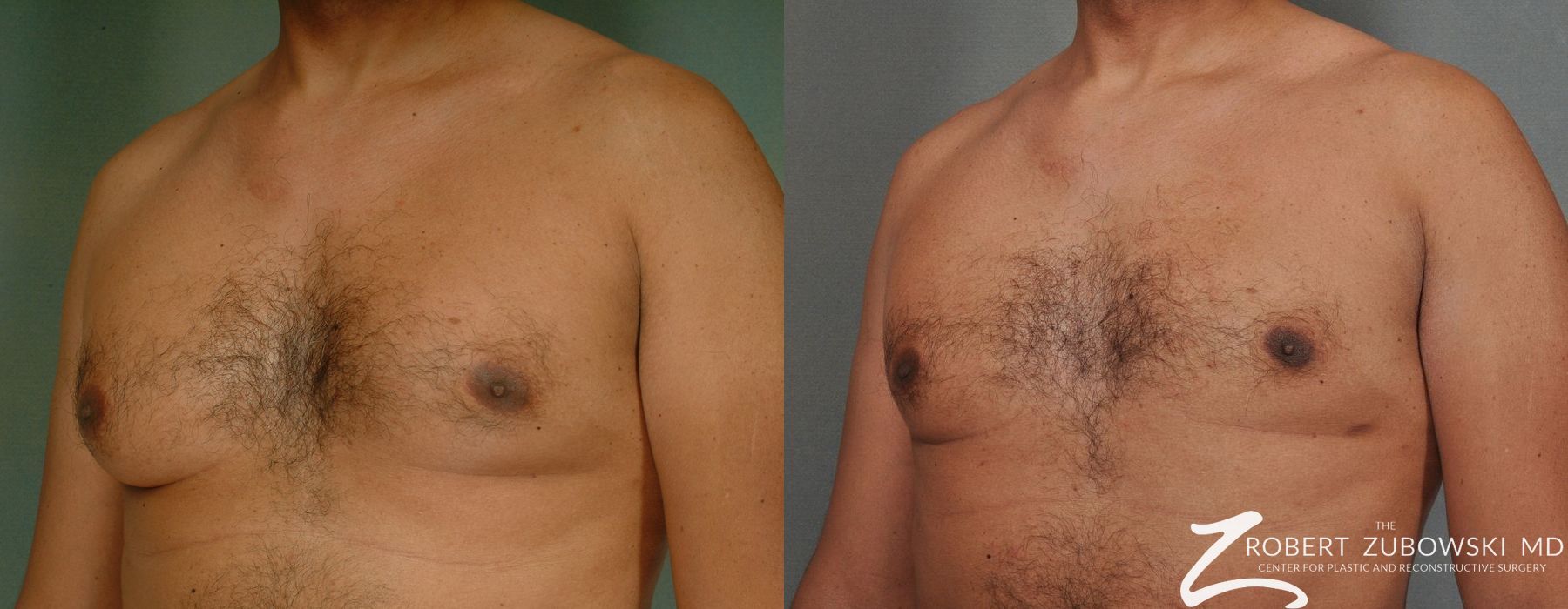 Gynecomastia - Thumbnail 2