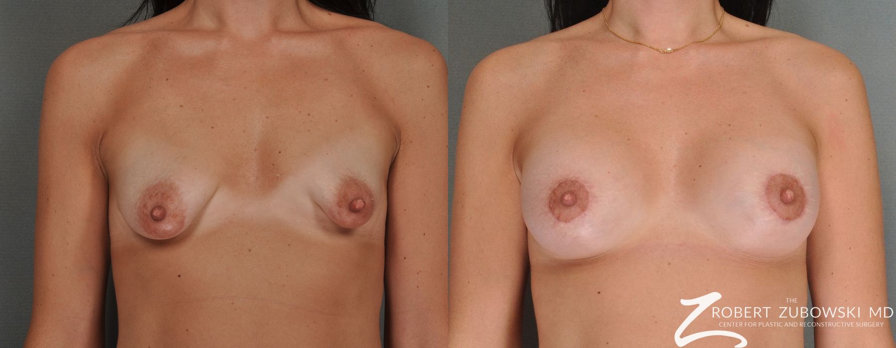 Breast Lift and Augmentation - Case 3674