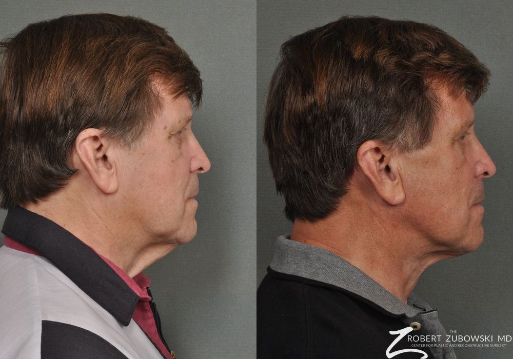 Neck Lift - Thumbnail 2