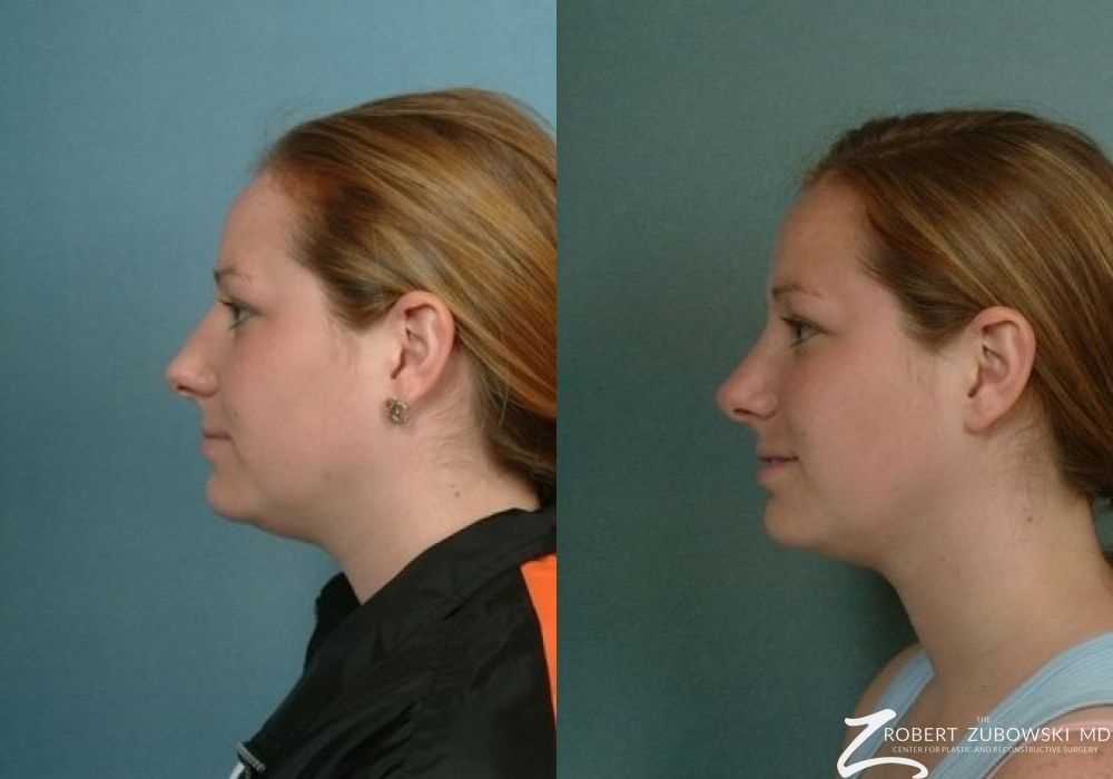 Rhinoplasty - Thumbnail 2