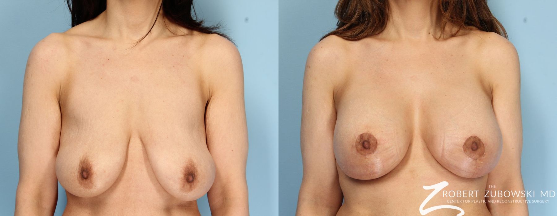 Breast Lift and Augmentation - Case 3664
