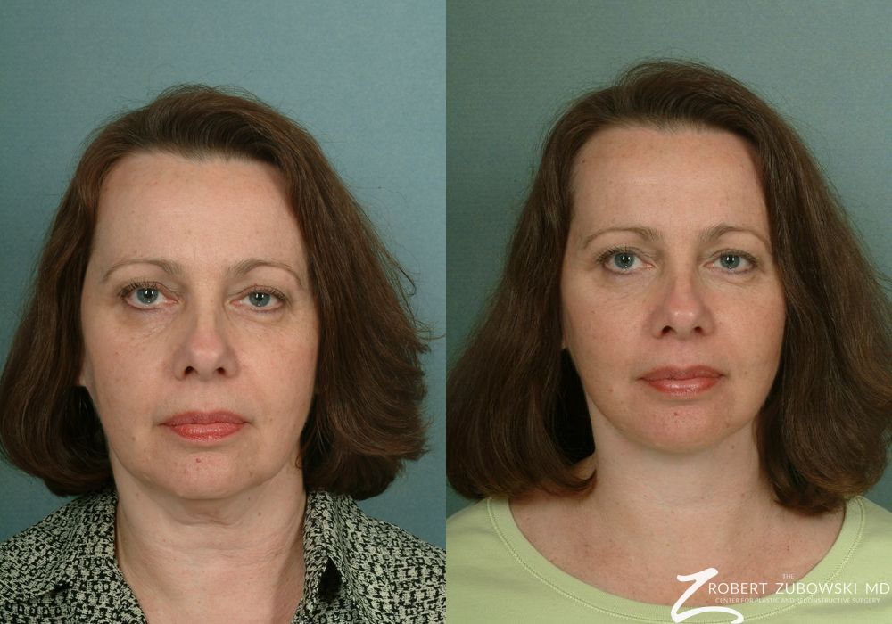 Before and after procedure result